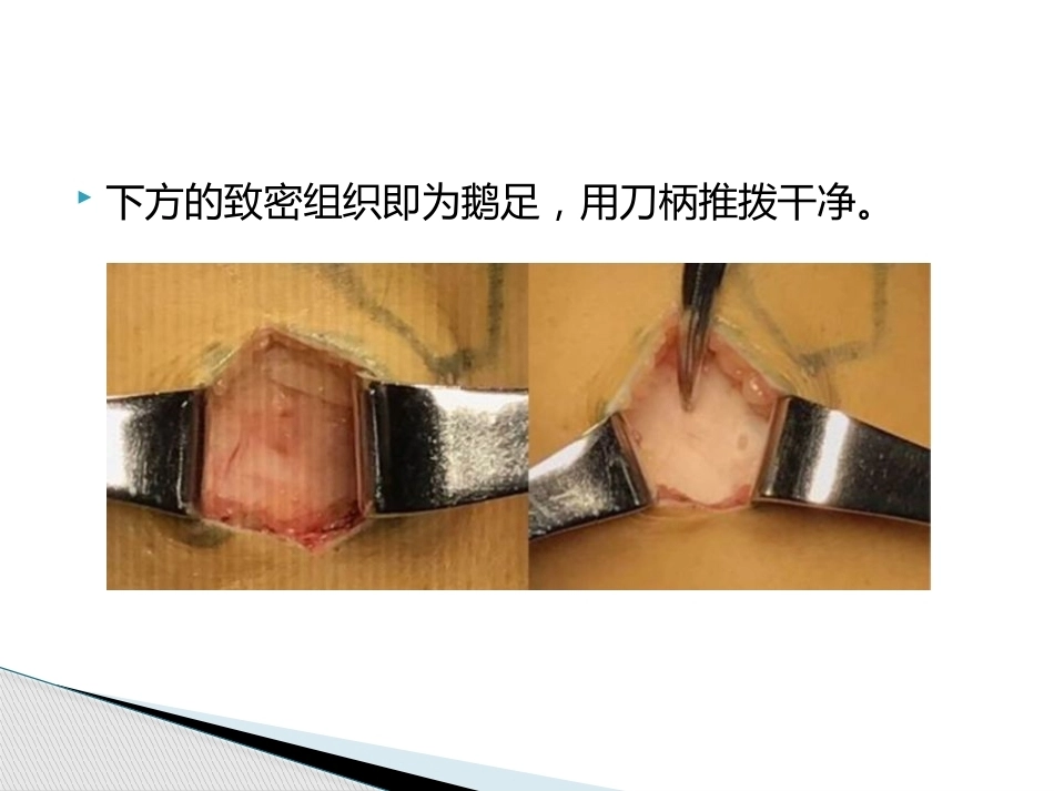 如何能够快速切取腘绳肌腱_第8页