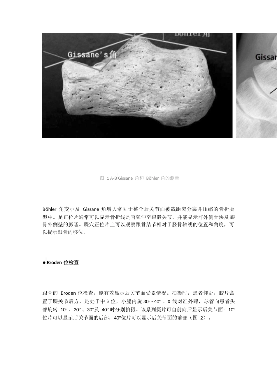 跟骨骨折的影像学检查与分型_第2页