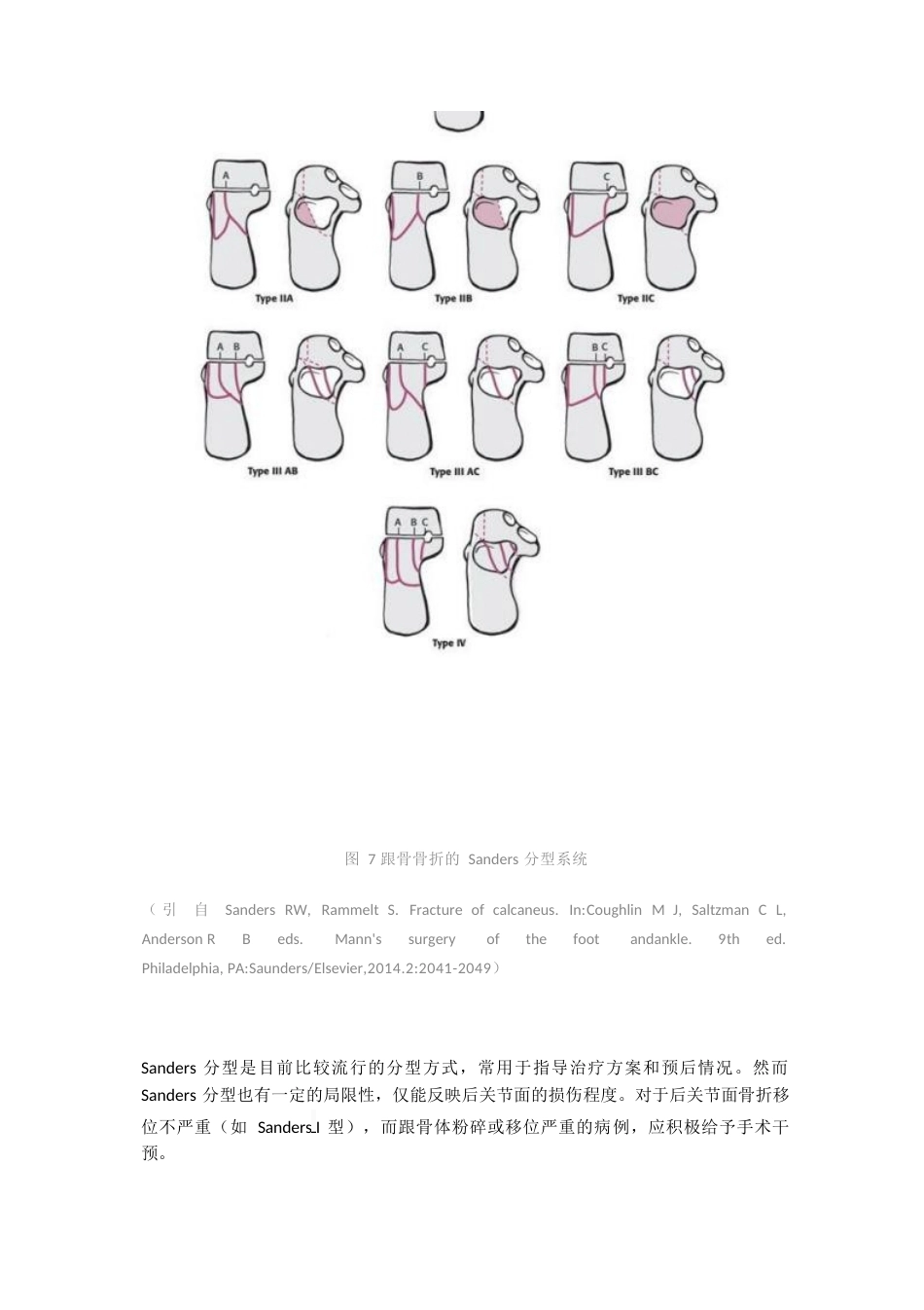 跟骨骨折的影像学检查与分型_第8页