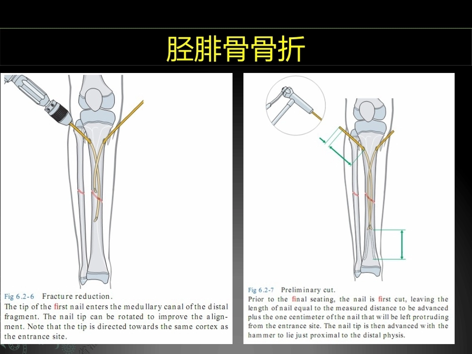 儿童长骨骨折弹性髓内钉课件_第10页