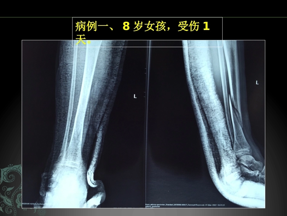 儿童长骨骨折弹性髓内钉课件_第11页