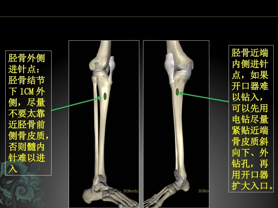 儿童长骨骨折弹性髓内钉课件_第12页