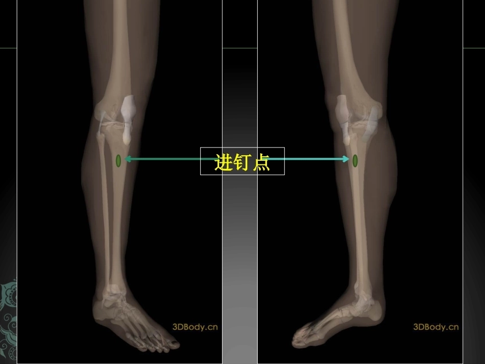 儿童长骨骨折弹性髓内钉课件_第13页