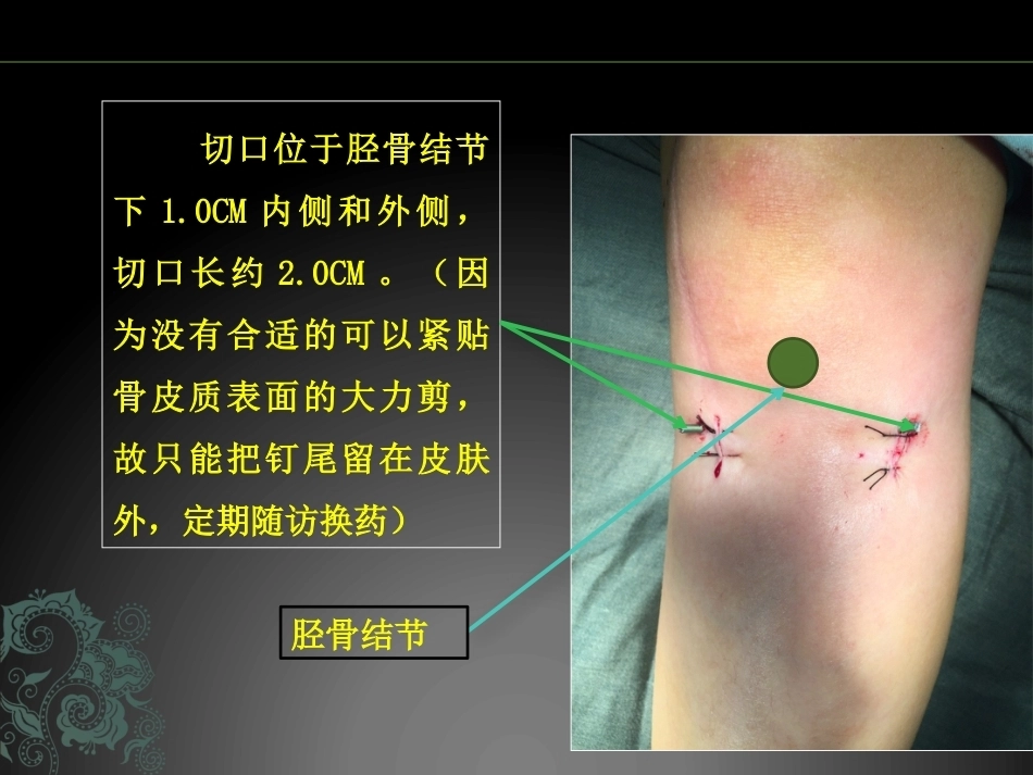 儿童长骨骨折弹性髓内钉课件_第14页