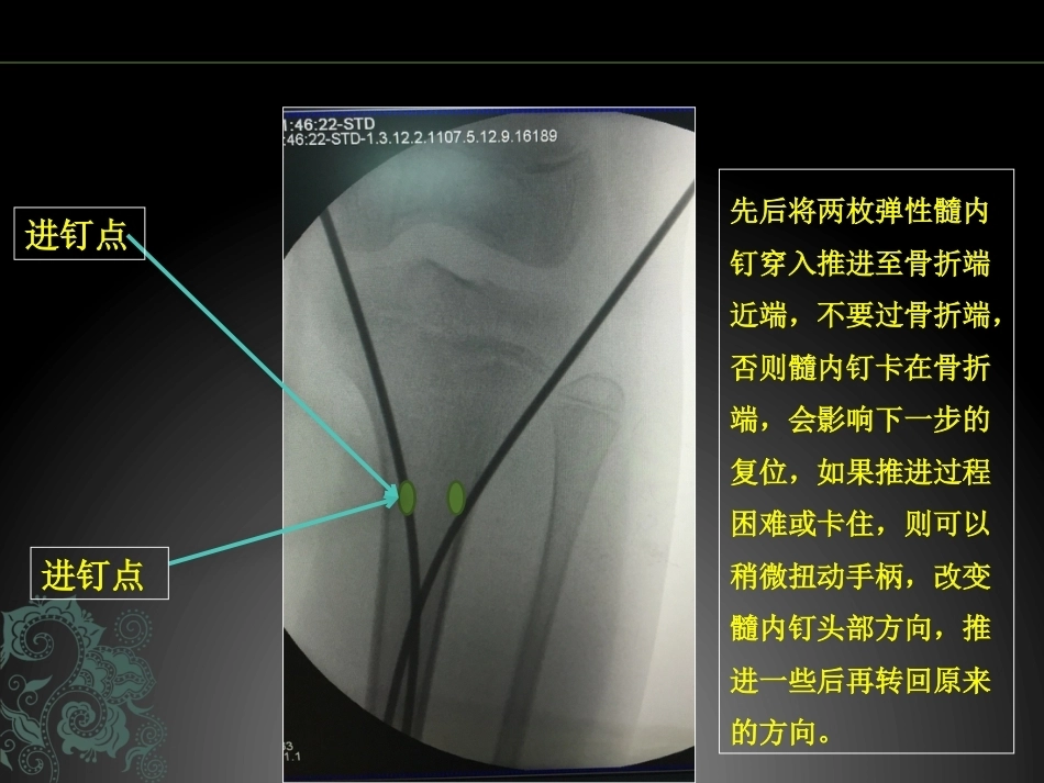 儿童长骨骨折弹性髓内钉课件_第15页