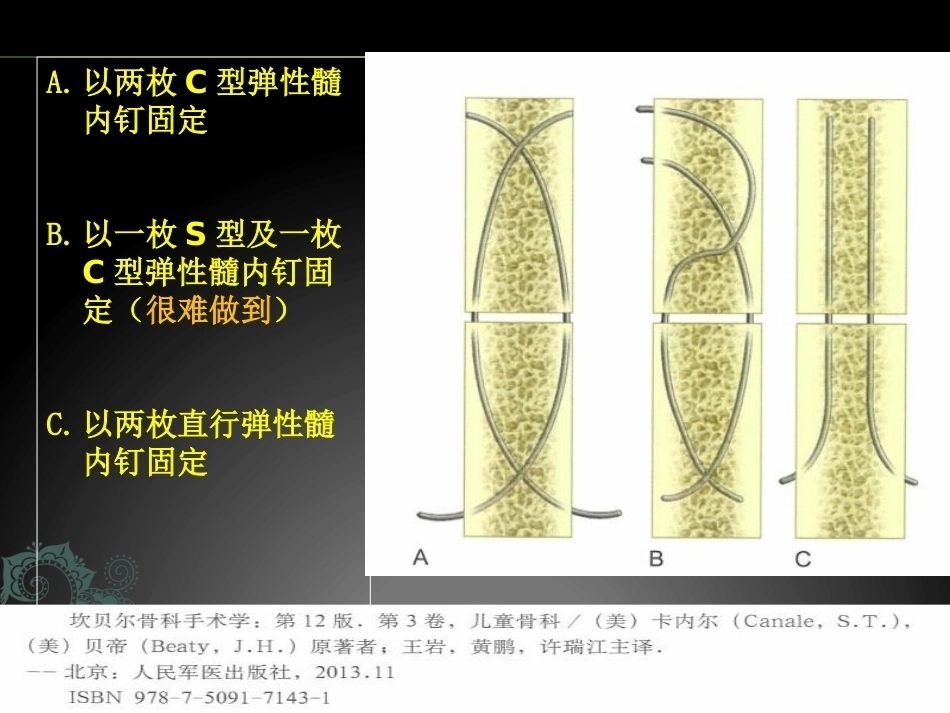 儿童长骨骨折弹性髓内钉课件_第4页