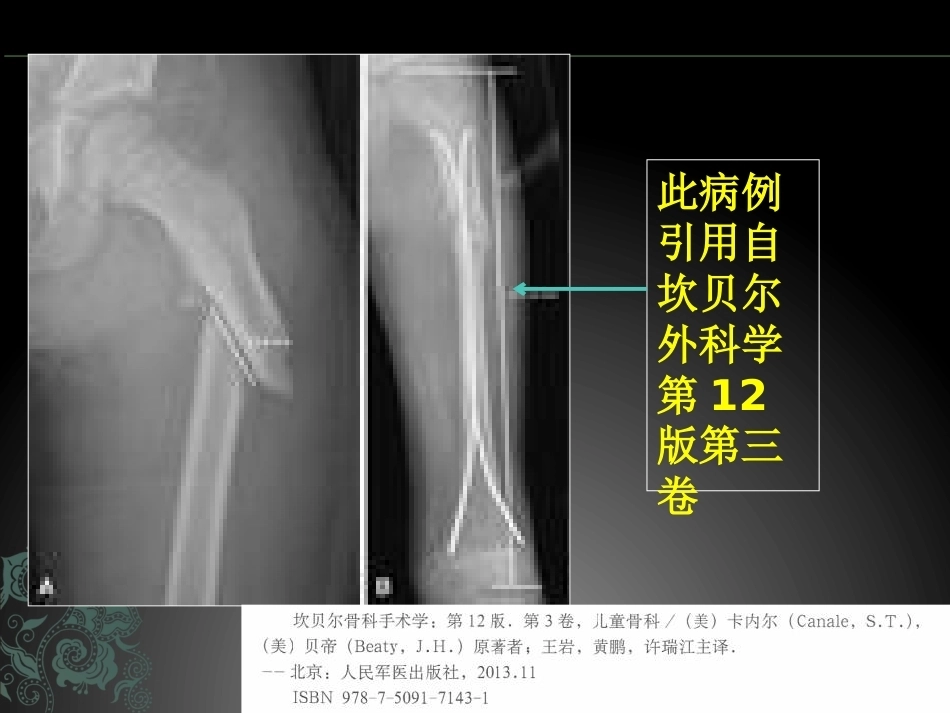 儿童长骨骨折弹性髓内钉课件_第6页