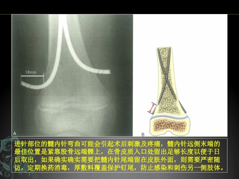 儿童长骨骨折弹性髓内钉课件_第7页