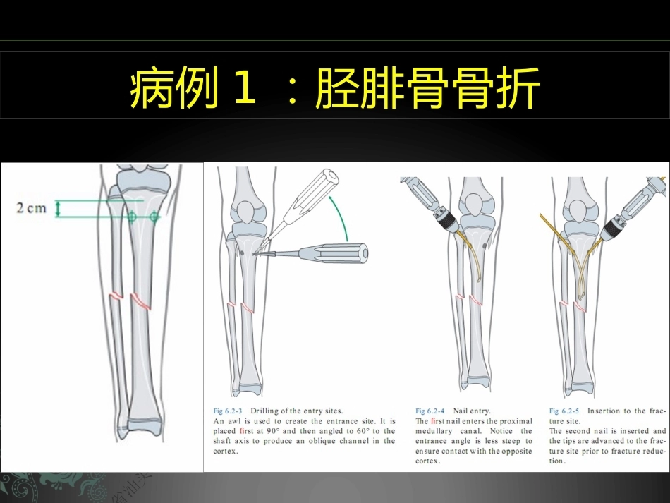 儿童长骨骨折弹性髓内钉课件_第9页