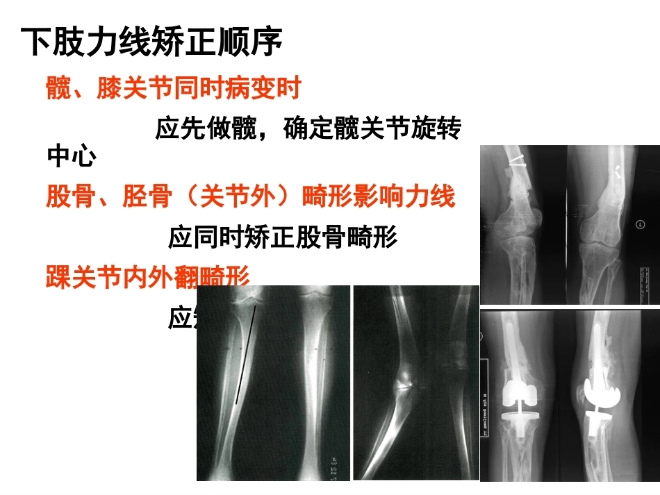 全膝 关节置换的 手术原则_第8页