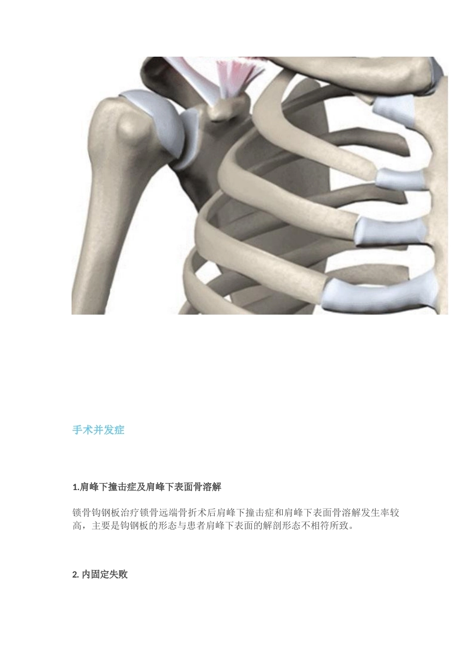 锁骨远端骨折分型_第2页