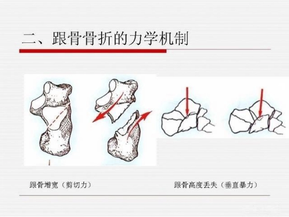 跟骨骨折ORIF的技巧_第10页