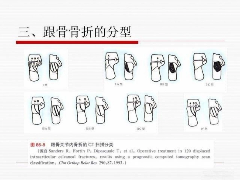 跟骨骨折ORIF的技巧_第12页