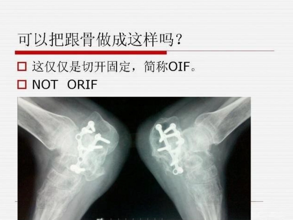 跟骨骨折ORIF的技巧_第4页