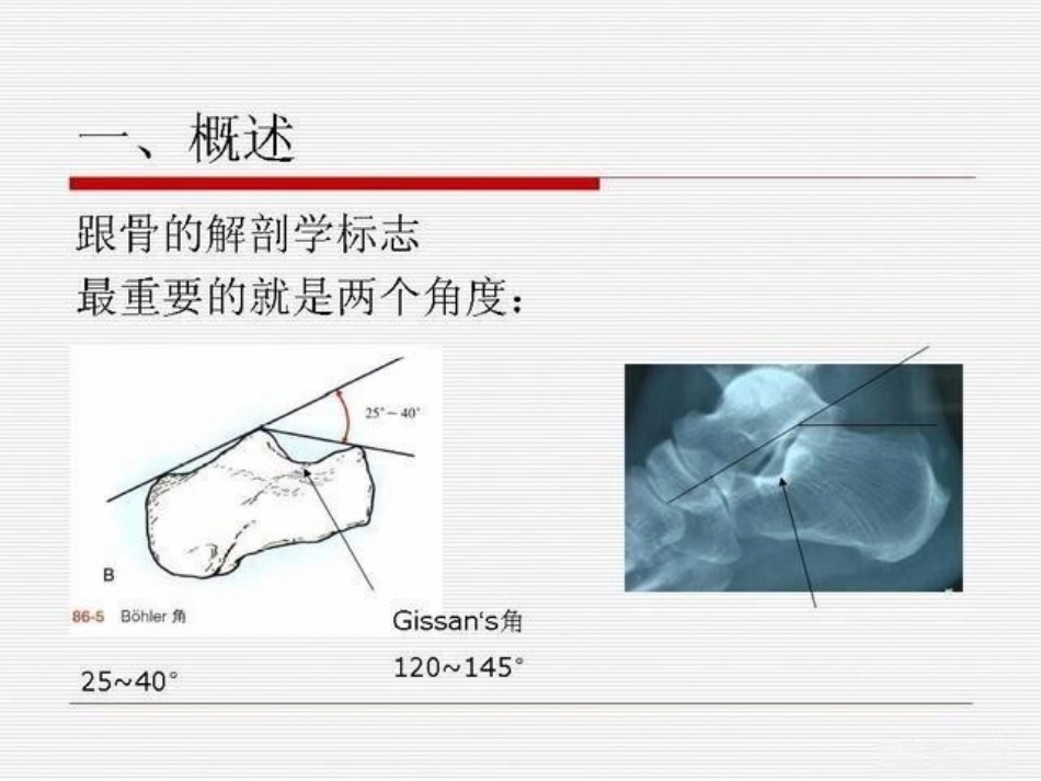跟骨骨折ORIF的技巧_第7页