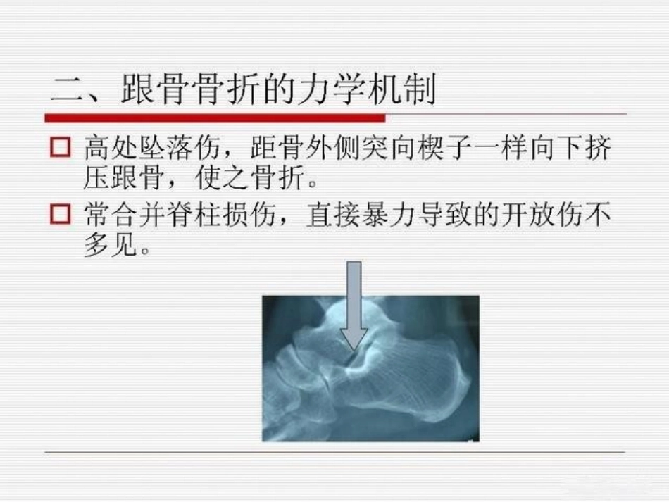 跟骨骨折ORIF的技巧_第9页