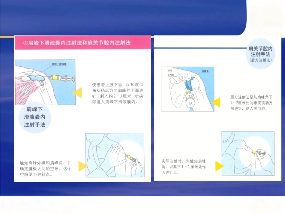 关节穿刺术_第8页