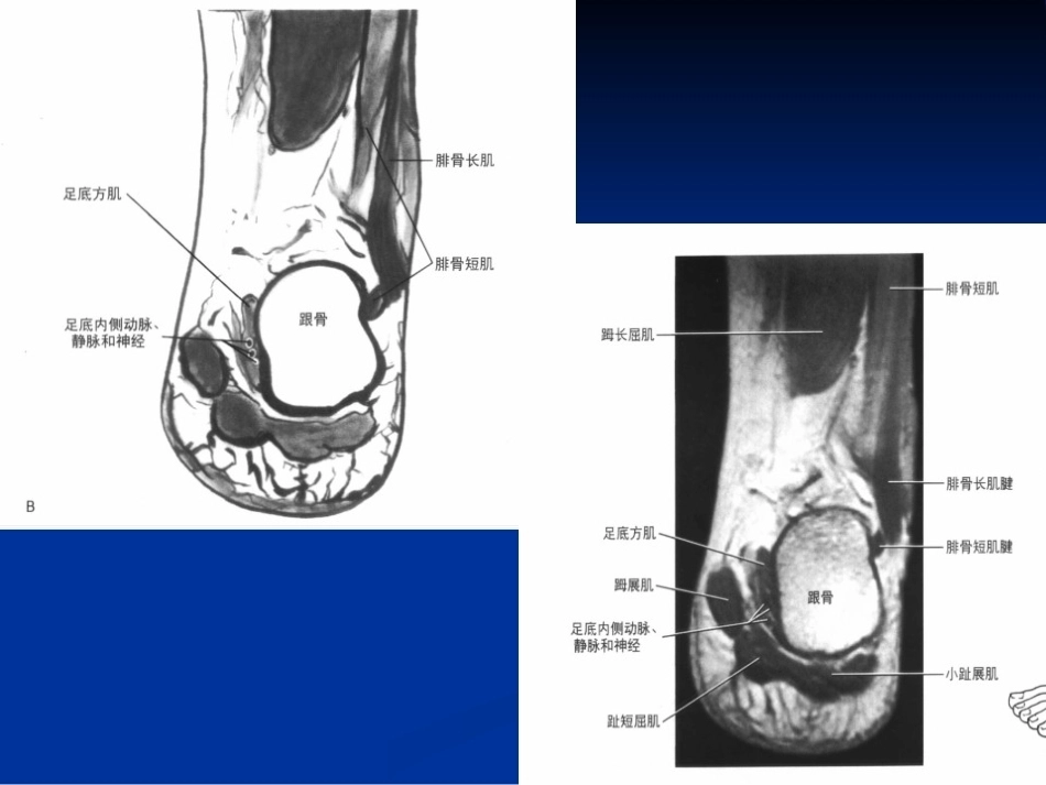 踝关节的MR诊断和解剖_第13页