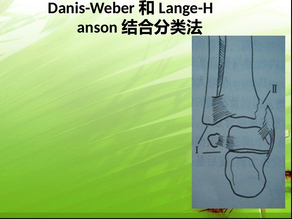 踝关节骨折的分型---讲课用_第12页
