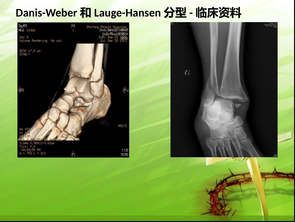 踝关节骨折的分型---讲课用_第15页