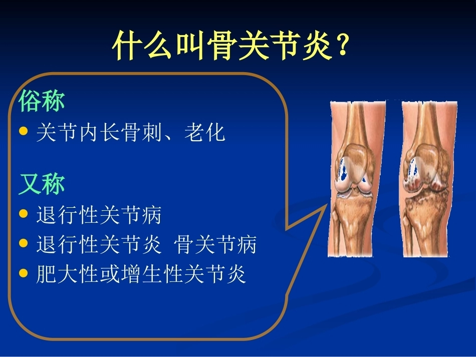 膝关节骨性关节炎的分 级治疗_第2页