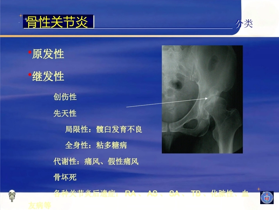 膝关节骨性关节炎的分 级治疗_第4页