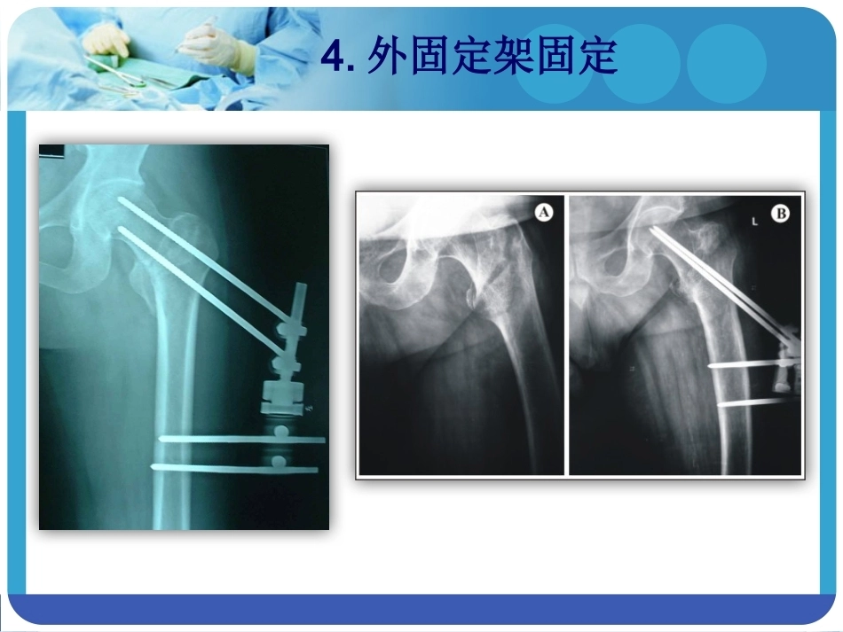 PFNA在股骨粗隆间骨折的应用_第10页