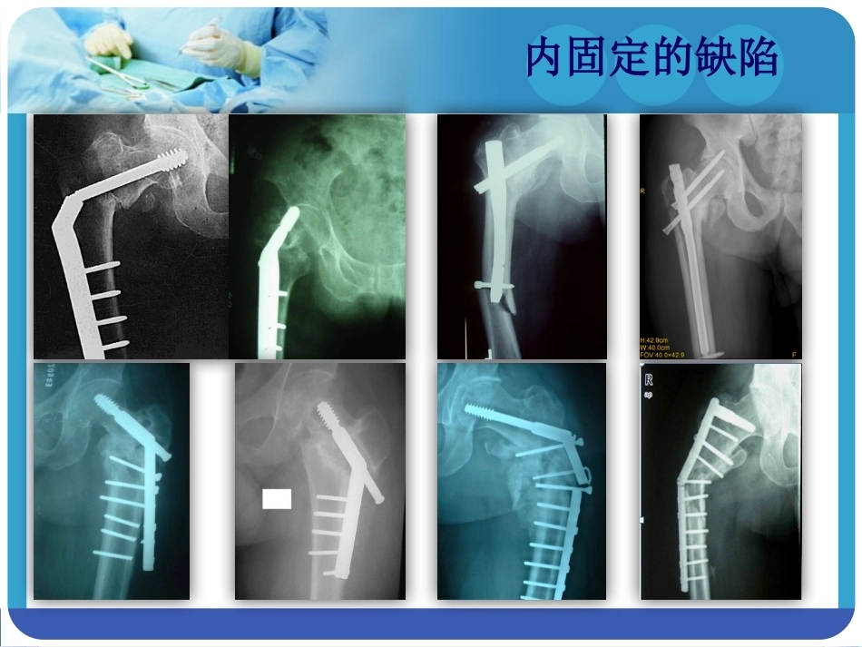 PFNA在股骨粗隆间骨折的应用_第11页