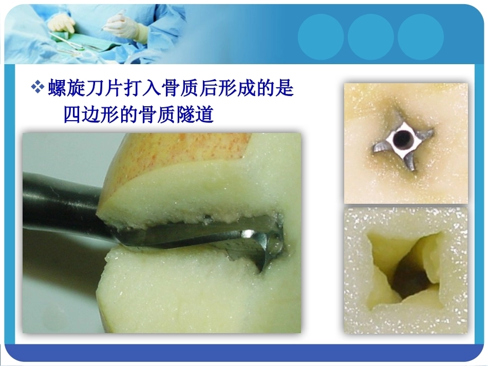 PFNA在股骨粗隆间骨折的应用_第13页
