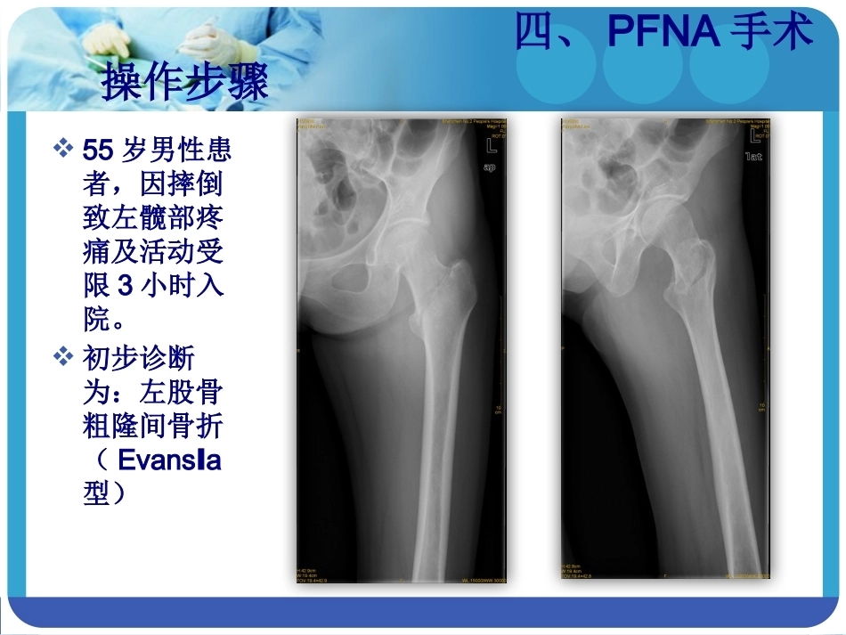 PFNA在股骨粗隆间骨折的应用_第14页