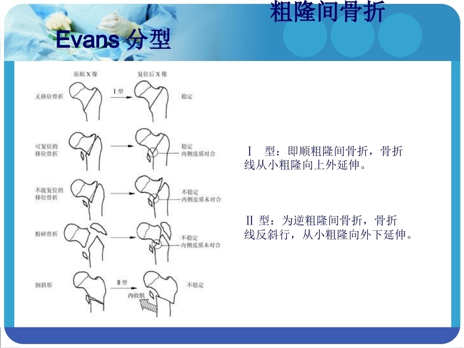 PFNA在股骨粗隆间骨折的应用_第4页