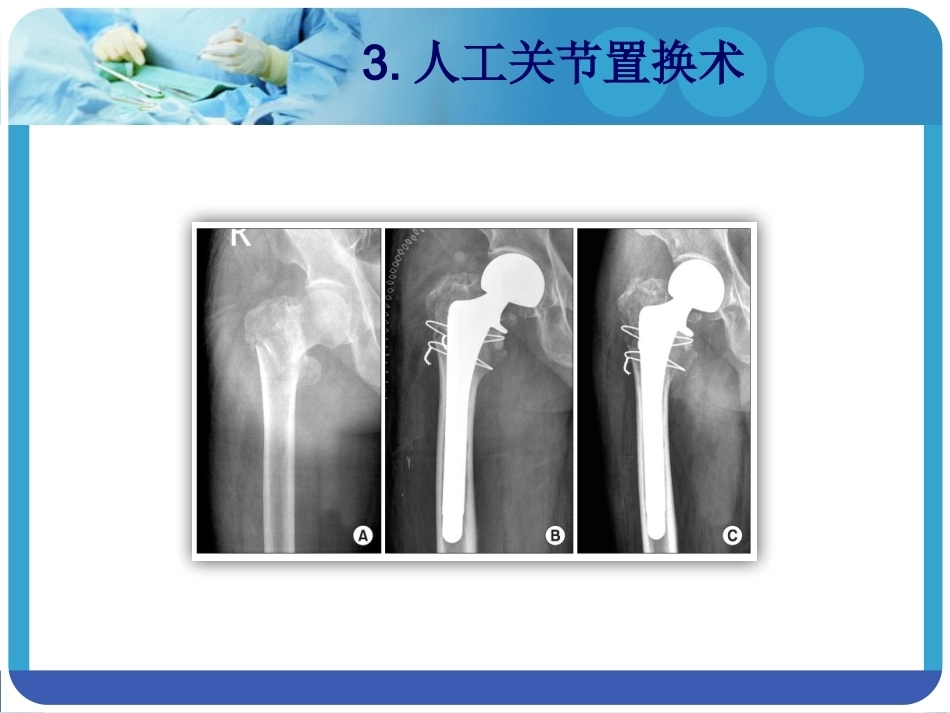 PFNA在股骨粗隆间骨折的应用_第9页