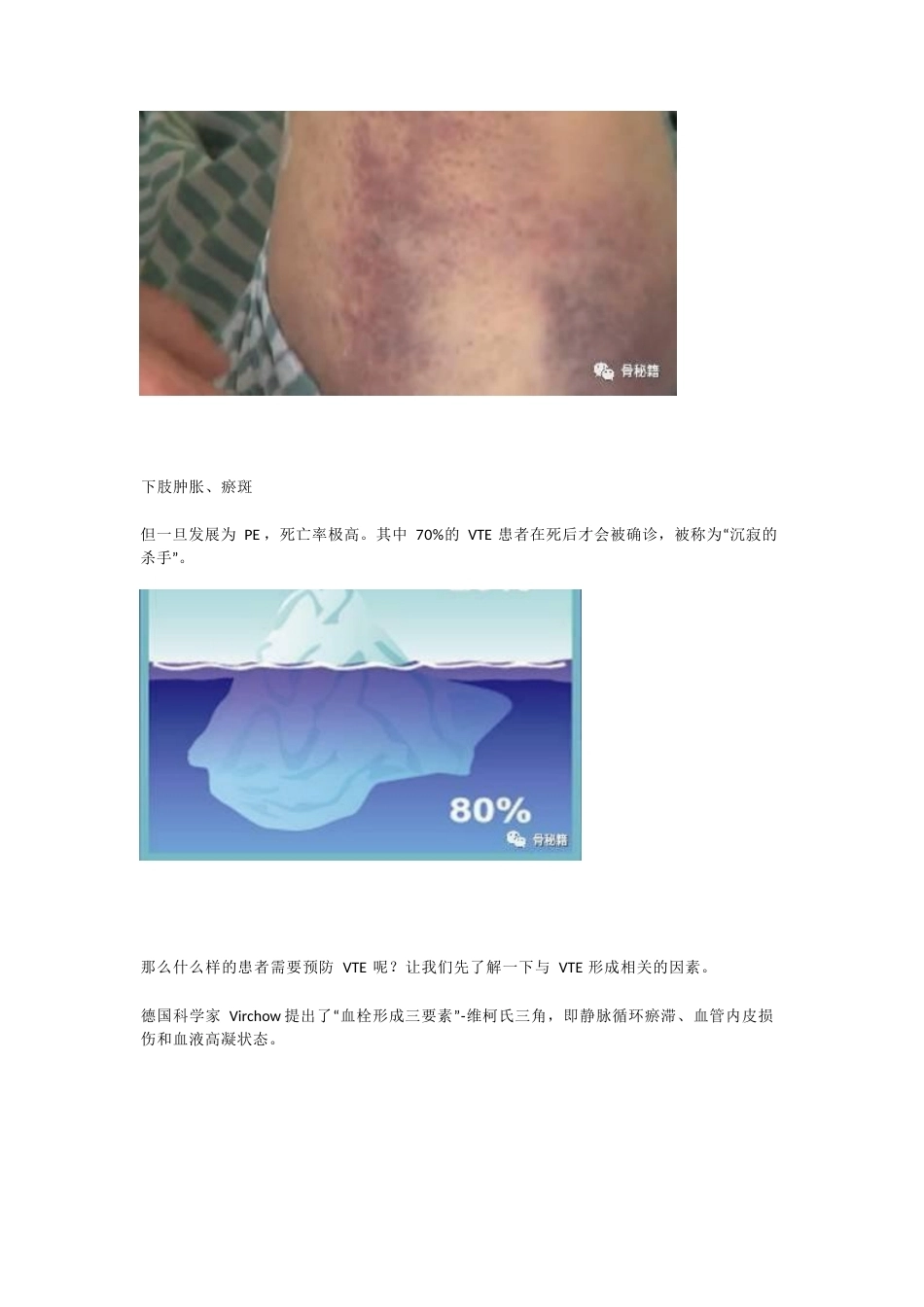 骨科患者静脉血 栓的筛查与预防策略_第3页