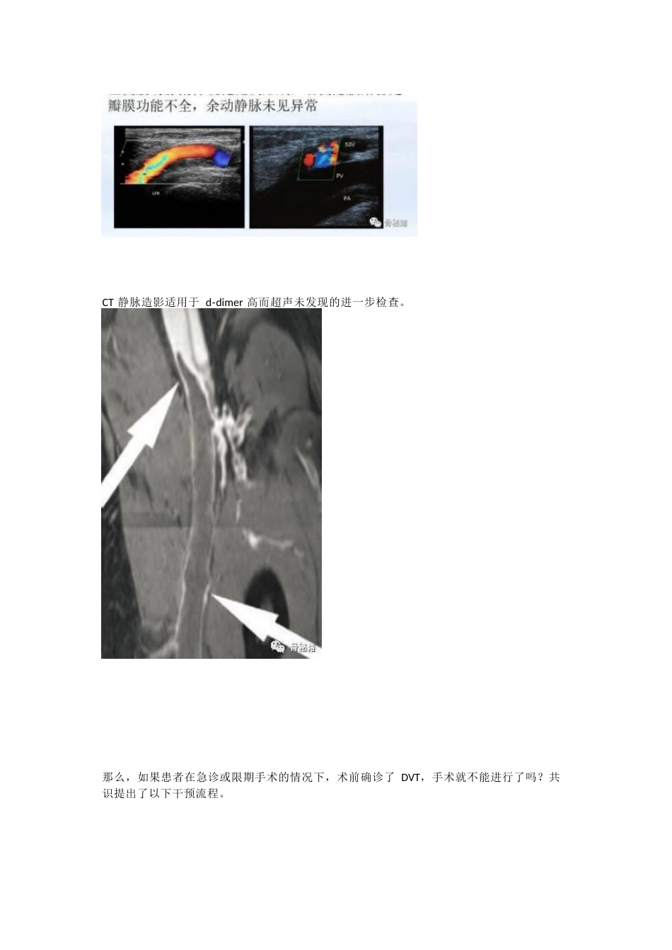 骨科患者静脉血 栓的筛查与预防策略_第6页