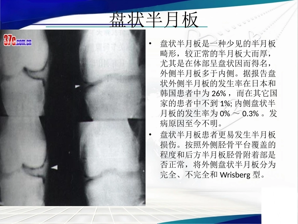 膝关节解 剖及关节镜手术_第14页