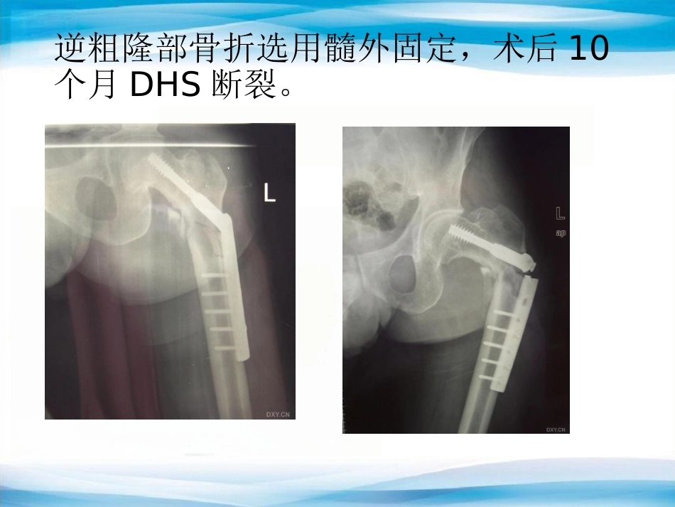 内植物断裂原因分析_第10页