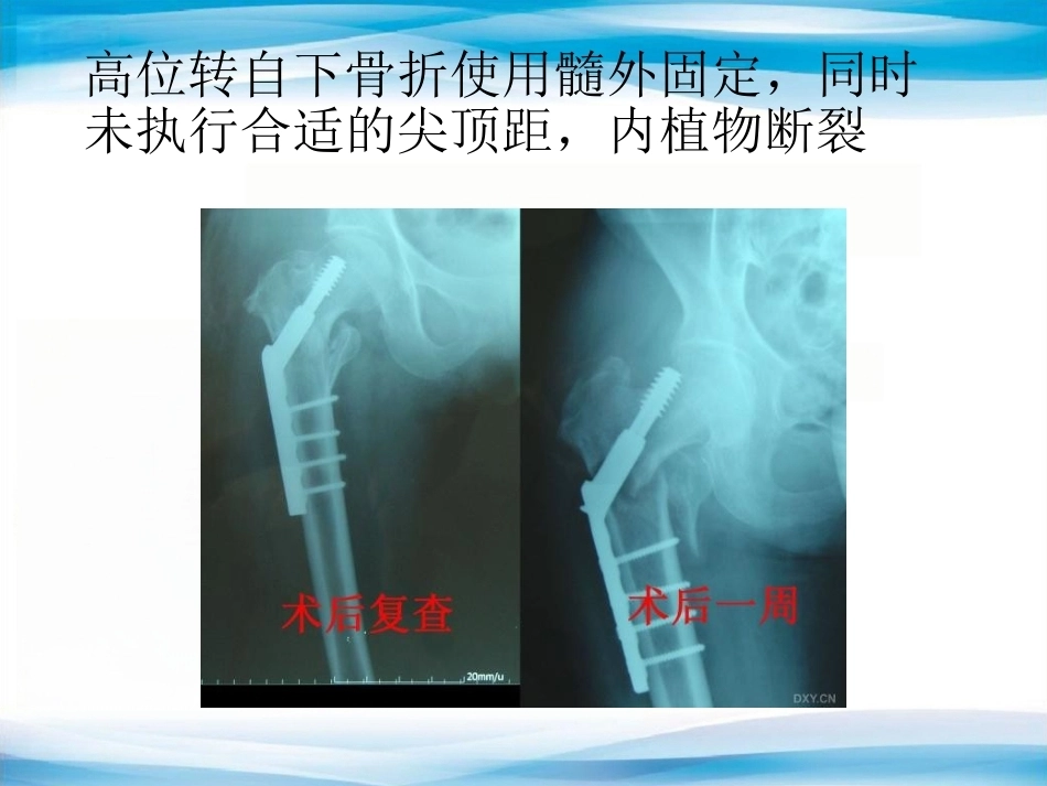内植物断裂原因分析_第11页