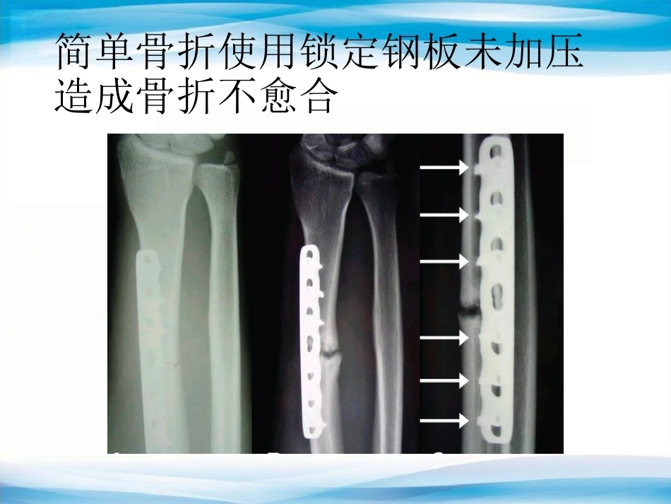 内植物断裂原因分析_第12页
