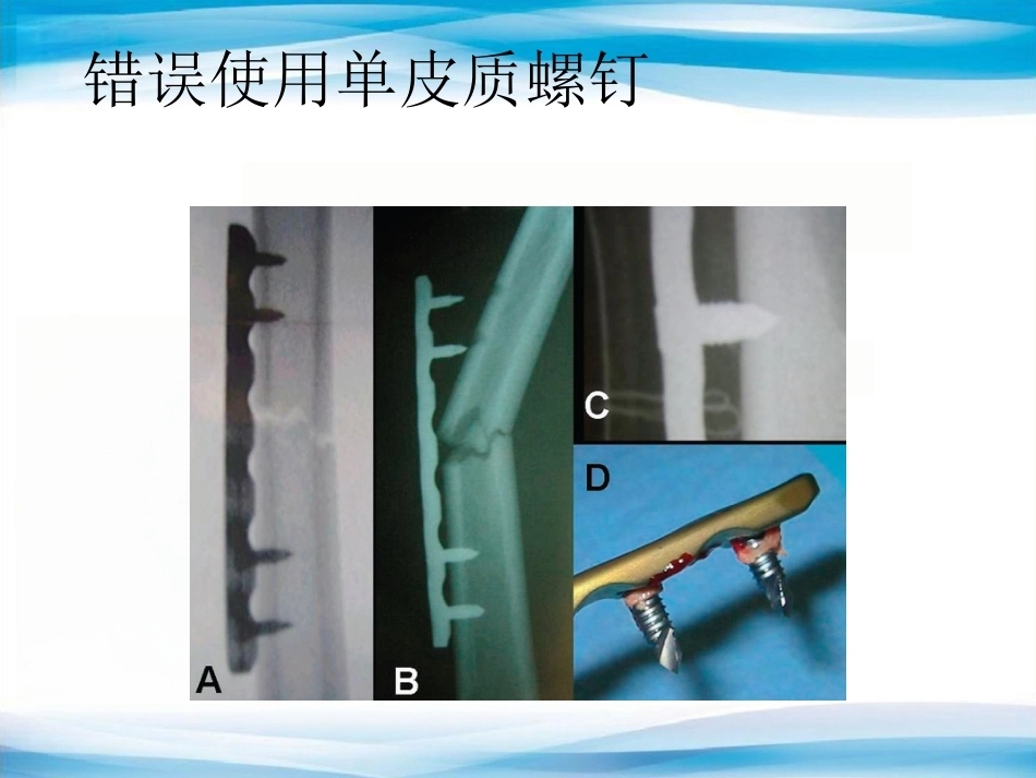 内植物断裂原因分析_第13页