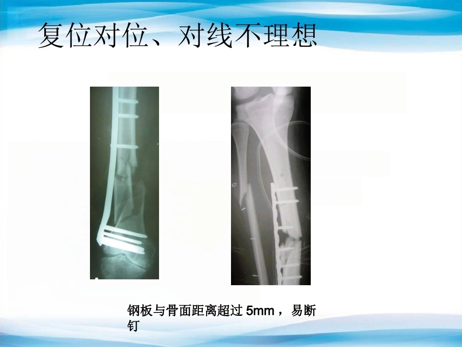 内植物断裂原因分析_第14页