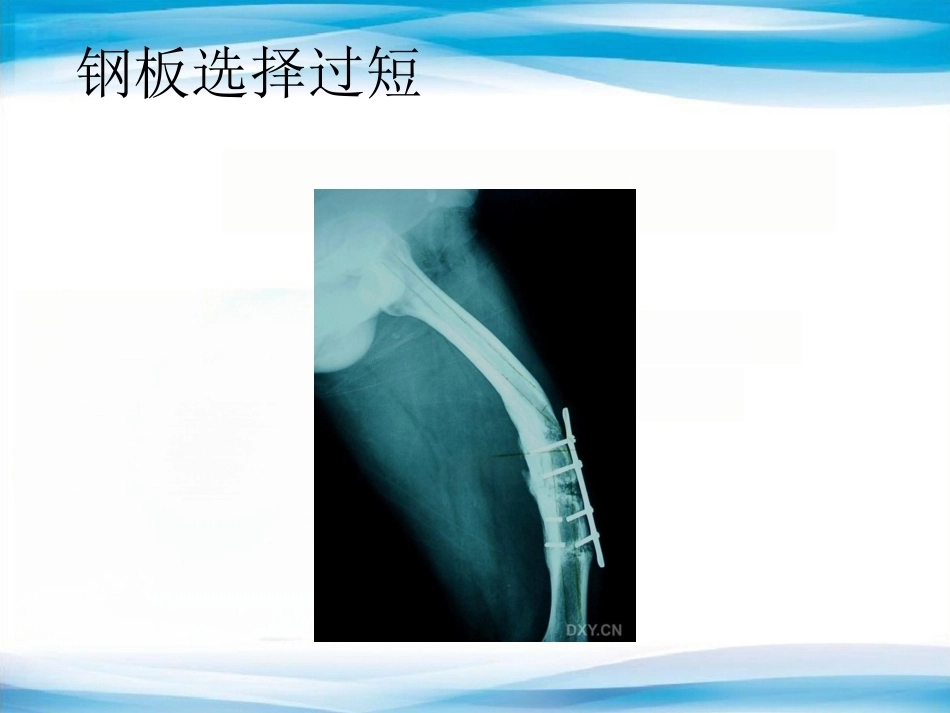 内植物断裂原因分析_第15页
