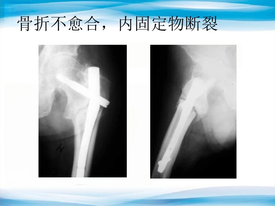 内植物断裂原因分析_第5页