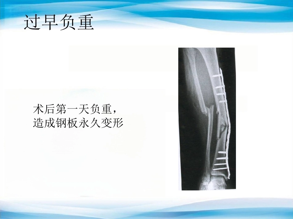 内植物断裂原因分析_第6页