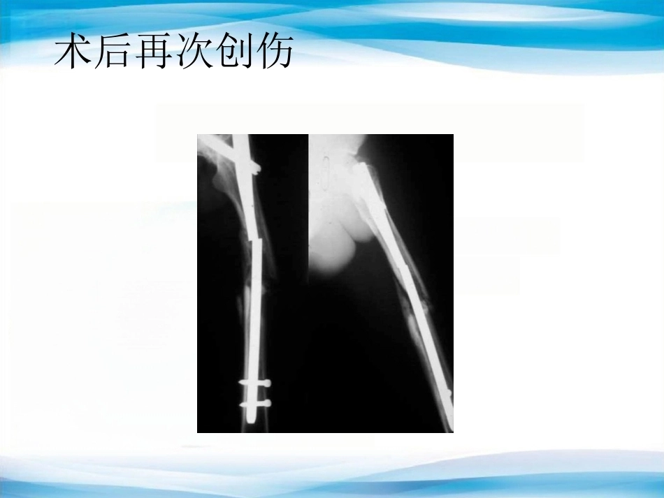 内植物断裂原因分析_第7页