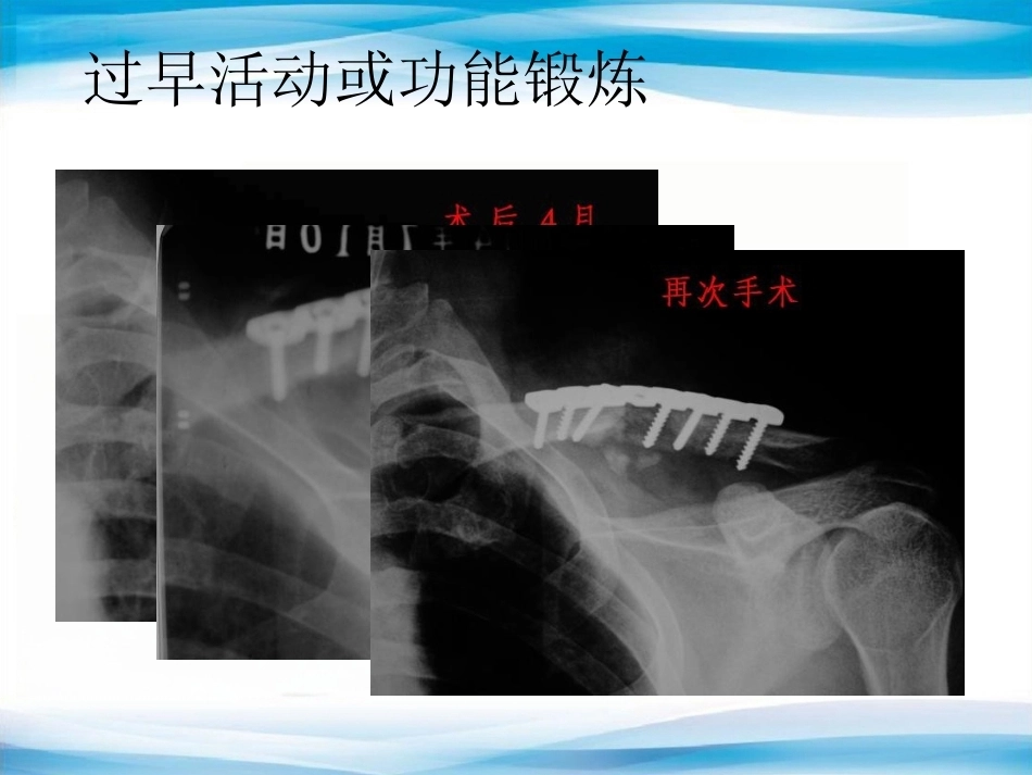 内植物断裂原因分析_第8页