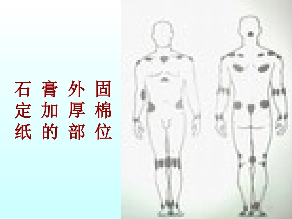骨折石膏外固定详解_第5页