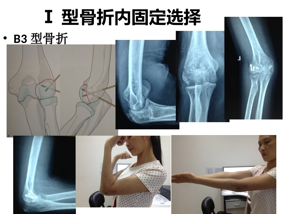 肱骨小头骨折的手术技巧_第10页