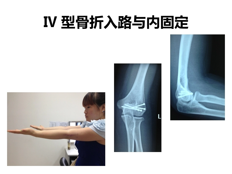 肱骨小头骨折的手术技巧_第11页