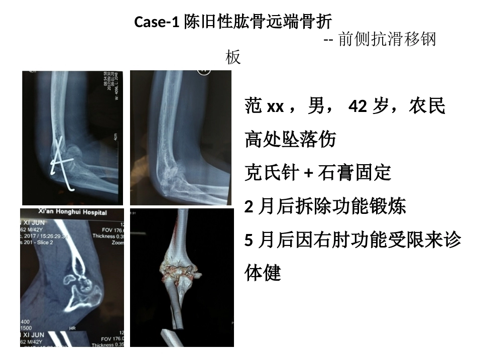 肱骨小头骨折的手术技巧_第15页