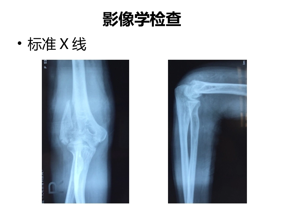 肱骨小头骨折的手术技巧_第7页